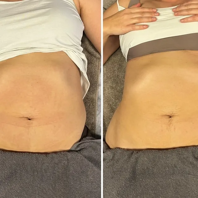 Sichtbares Ergebnis nach Lymphdrainage
